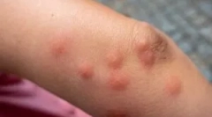 Alergija na ugriz claop