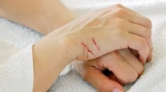 Bolezni, ki se prenašajo skozi ugrizi in praske