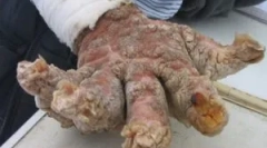 Kaj je nevarna filyroza: simptomi in zdravljenje