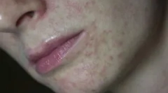 Demodekoza: kaj je, simptomi in zdravljenje