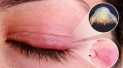 Demodekoza: vzroki, simptomi in zdravljenje