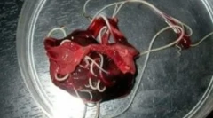 Črvi v jetrnih tkivih