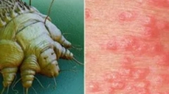 Učinkovita sredstva iz scabies