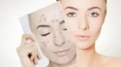 Zdravljenje demodikoze na obrazu osebe