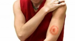 Zdravljenje borrelioze klopov