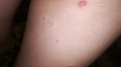 Zakaj nekateri ljudje ugriznejo bolhe in ni drugih