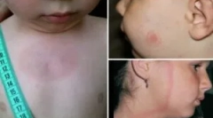 Simptomi in zdravljenje borelioze v otroku