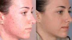 Sredstva za zdravljenje demodikoze