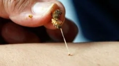 Sredstva iz uk ugriza